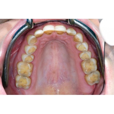 کامپوزیت انامل بیوفانکشن - Micerium - Ena Enamel Bio Function