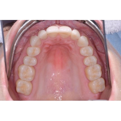 کامپوزیت انامل بیوفانکشن - Micerium - Ena Enamel Bio Function