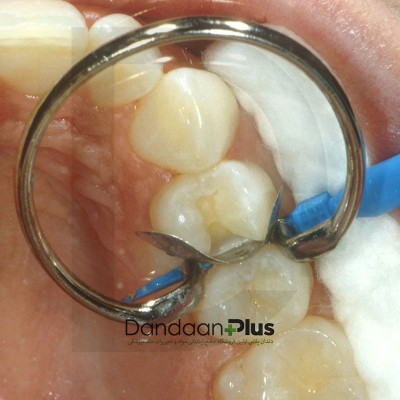 سیستم ماتریکس طلایی - Garrison - Composi-Tight Gold