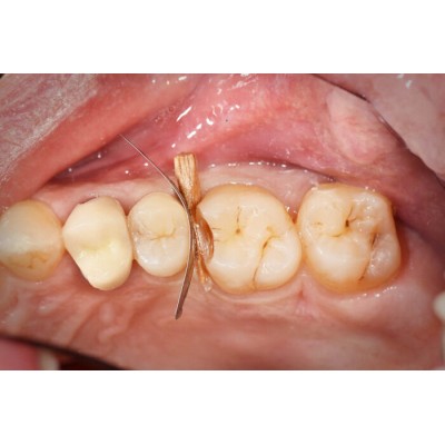 سکشنال ماتریس - Polydentia - PolydentiaPro