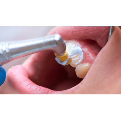 خمیر پروفیلاکسی ضدحساسیت یونیورسال - Directa - ProphyCare HAp Prophylaxis Paste