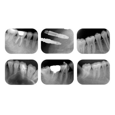 دستگاه فسفرپلیت - DentaFilm - Phosphor Plate