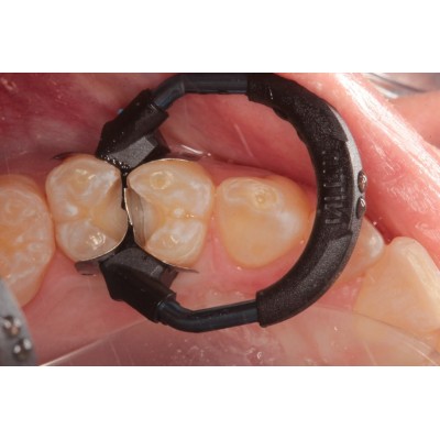 کیت سکشنال ماتریکس - Garrison - Nitinol Sectional Matrix System Kit