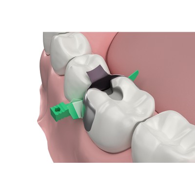 کیت سکشنال ماتریکس - Garrison - Strata-G Sectional Matrix System
