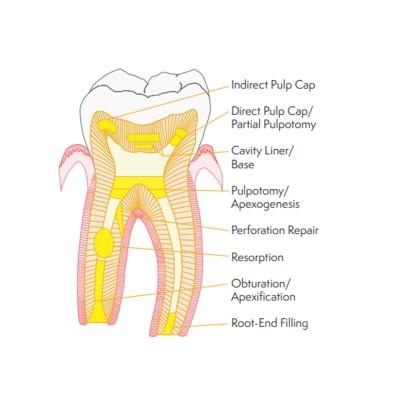 پوتی بایوسرامیک - Avalon Biomed - NeoPUTTY