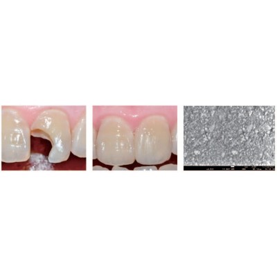 (تخفیف ویژه)کامپوزیت نانوهیبرید قدامی - Dentex - Anterior Composite
