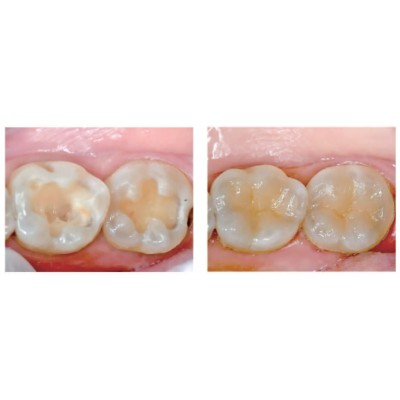 (تخفیف ویژه)کامپوزیت نانوهیبرید خلفی - Dentex - Posterior Composite