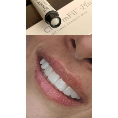 کامپوزیت نانوهیبرید - Dentkist - CharmFil Plus