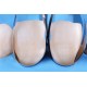 سکشنال ماتریس قدامی - Polydentia - Unica Anterior Matrix