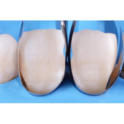 سکشنال ماتریس قدامی - Polydentia - Unica Anterior Matrix