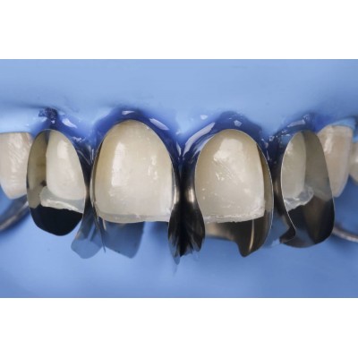 سکشنال ماتریس قدامی - Polydentia - Unica Minideep Anterior Matrix