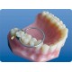 کیت نوار ماتریس سدل - TorVM - Saddle Metal Matrices