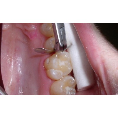 فورسپس ماتریکس - Garrison - Composi Tight Matrix Forceps