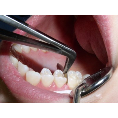 فورسپس ماتریکس - Garrison - Composi Tight Matrix Forceps