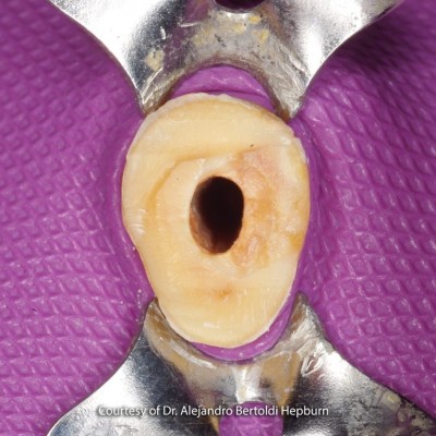 فایبر پست - RTD - Macro Lock Post Oval
