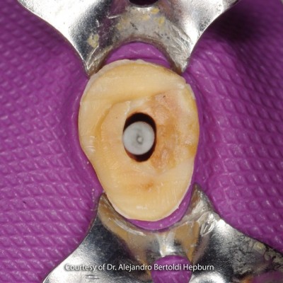 فایبر پست - RTD - Macro Lock Post Oval