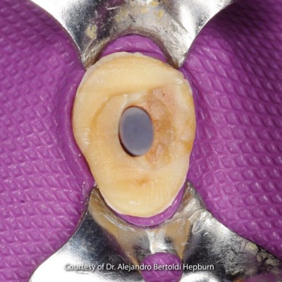 فایبر پست - RTD - Macro Lock Post Oval