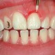 کیت فرز سرامیکی تریمر لثه - Microdont - CTT