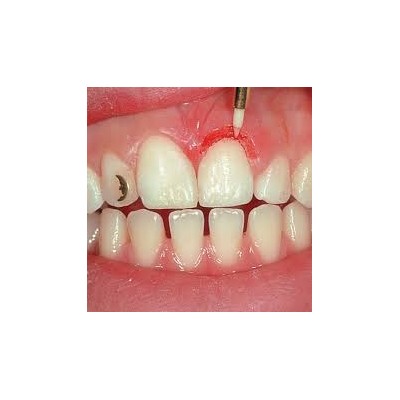 کیت فرز سرامیکی تریمر لثه - Microdont - CTT