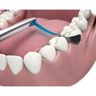 کیت وج بندآورنده خون - Garrison - A+ Wedge