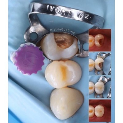 نوار ماتریس مولار و پری‌مولار - Polydentia - Quickmat All-Round