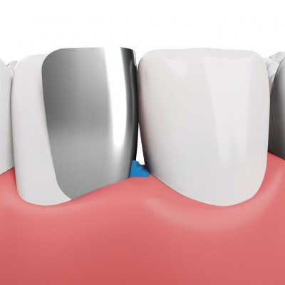 کیت وج و ماتریکس - Garrison - Fusion Anterior Matrix Kit