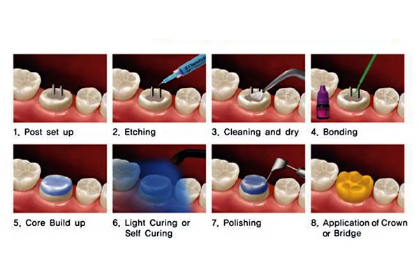 DENTEX Dual Cure Build-up Core Composite