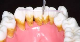 periodontal splint.jpg